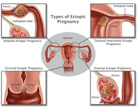 Ectopic Pregnancy Educational Poster Print by Science Source