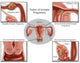 Ectopic Pregnancy Educational Poster Print by Science Source