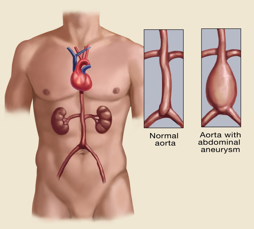 Abdominal Aneurysm Anatomical Poster Print showcasing detailed anatomy.