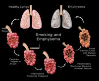 Lung Damage Leading to Emphysema Poster Print showcasing respiratory health.