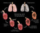 Lung Damage Leading to Emphysema Poster Print showcasing respiratory health.