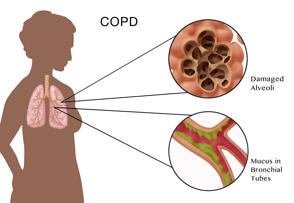 Chronic Obstructive Pulmonary Disease (COPD) Educational Poster Print by Monica Schroeder