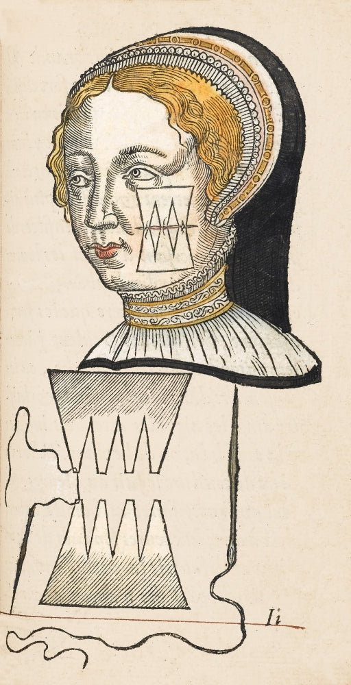 Pare Suture 1500s Poster Print showcasing historical medical techniques.