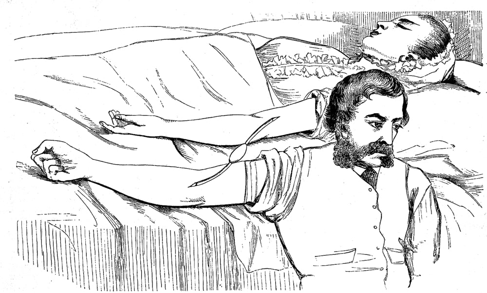 Obstetric Blood Transfusion Historical Poster Print from 1873.