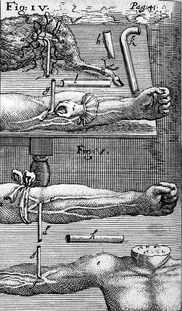 Techniques of Blood Transfusion, 1667 Poster Print showcasing historical medical advancements.