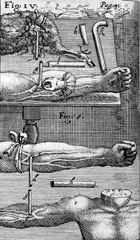 Techniques of Blood Transfusion, 1667 Poster Print showcasing historical medical advancements.