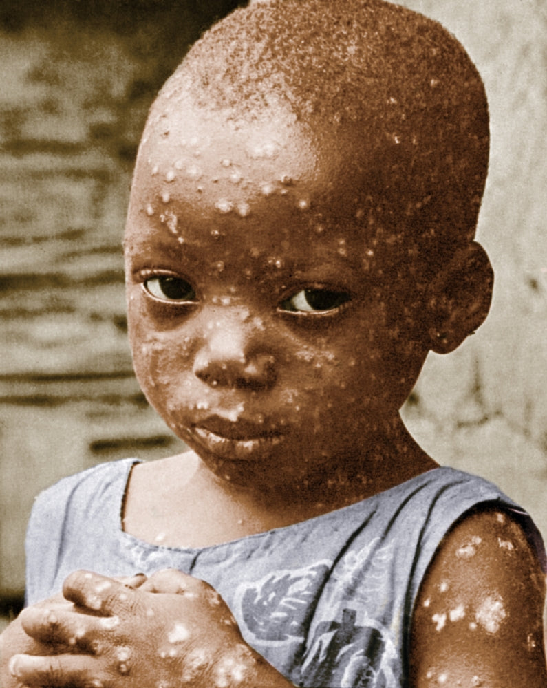 Child With Smallpox Historical Poster Print by Science Source
