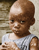 Child With Smallpox Historical Poster Print by Science Source