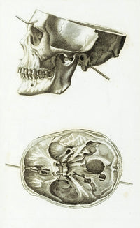 Skull with Head Wound 1829 illustration poster print.