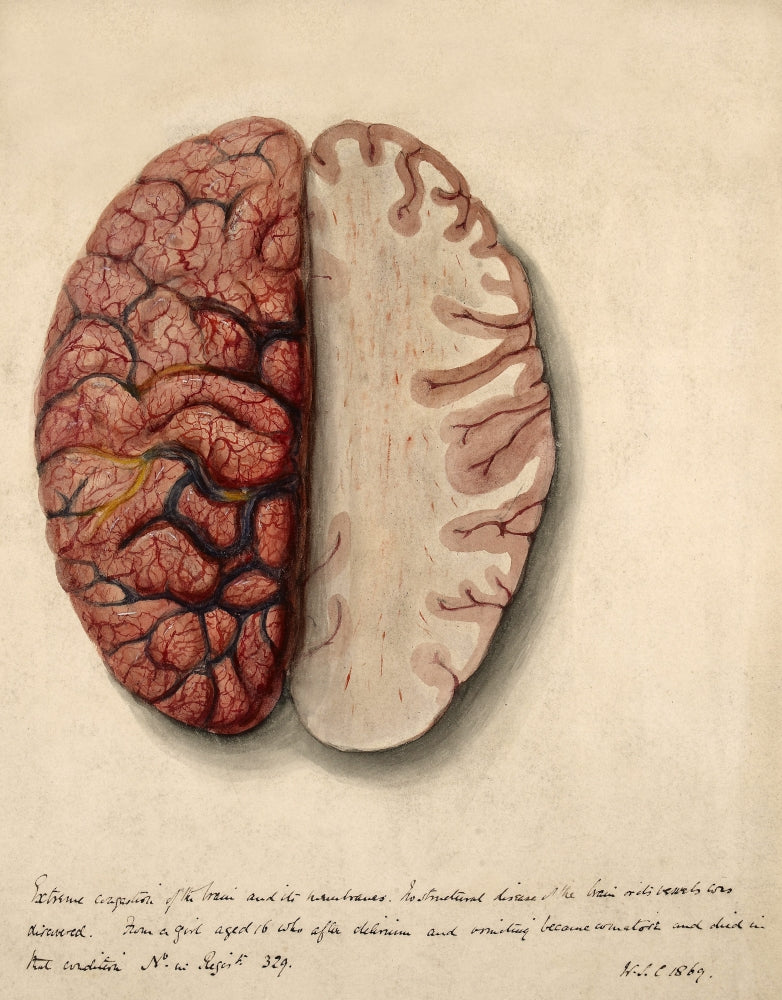 Brain Illustration showing extreme congestion from 1869, poster print.
