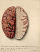 Brain Illustration showing extreme congestion from 1869, poster print.