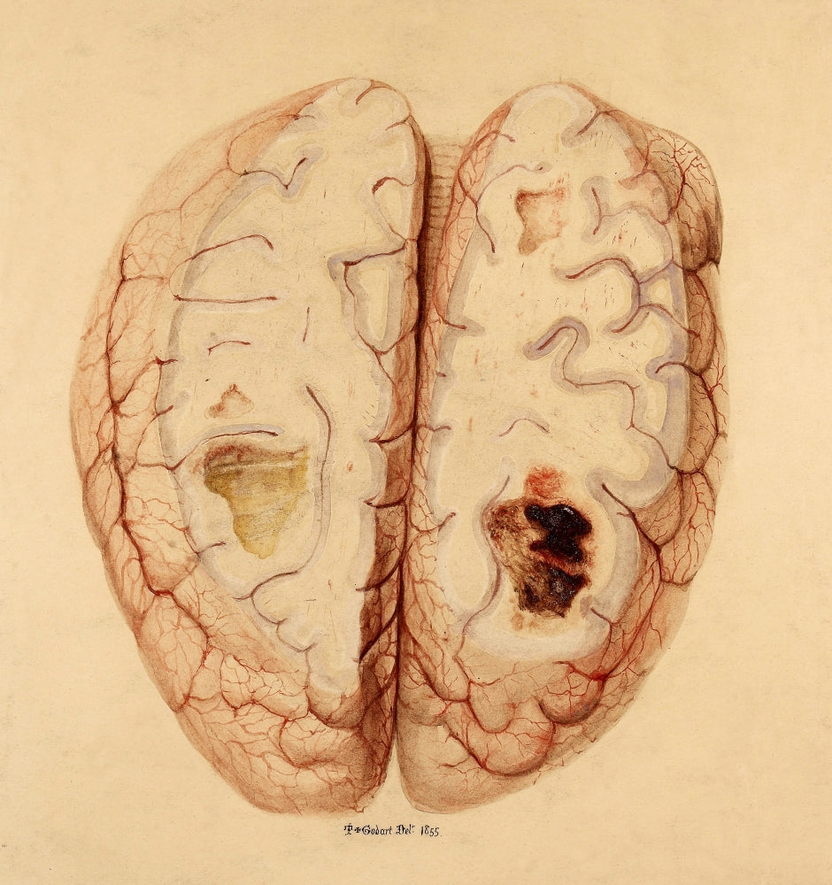 Extravasated Blood, Brain illustration poster print from 1855