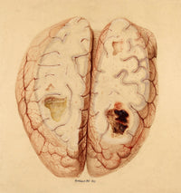 Extravasated Blood, Brain illustration poster print from 1855
