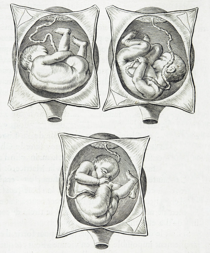 Historical illustration of pregnancy complications from 1668, available as a poster print.