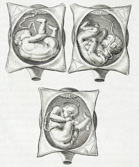Historical illustration of pregnancy complications from 1668, available as a poster print.