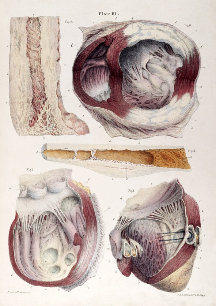 Heart Aneurysm Illustration Poster Print from 1838