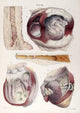 Heart Aneurysm Illustration Poster Print from 1838