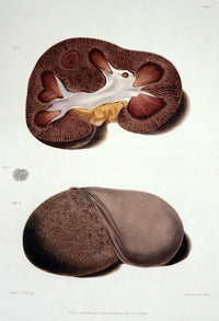 Diseased Kidney Sections Illustration Poster Print from 1827