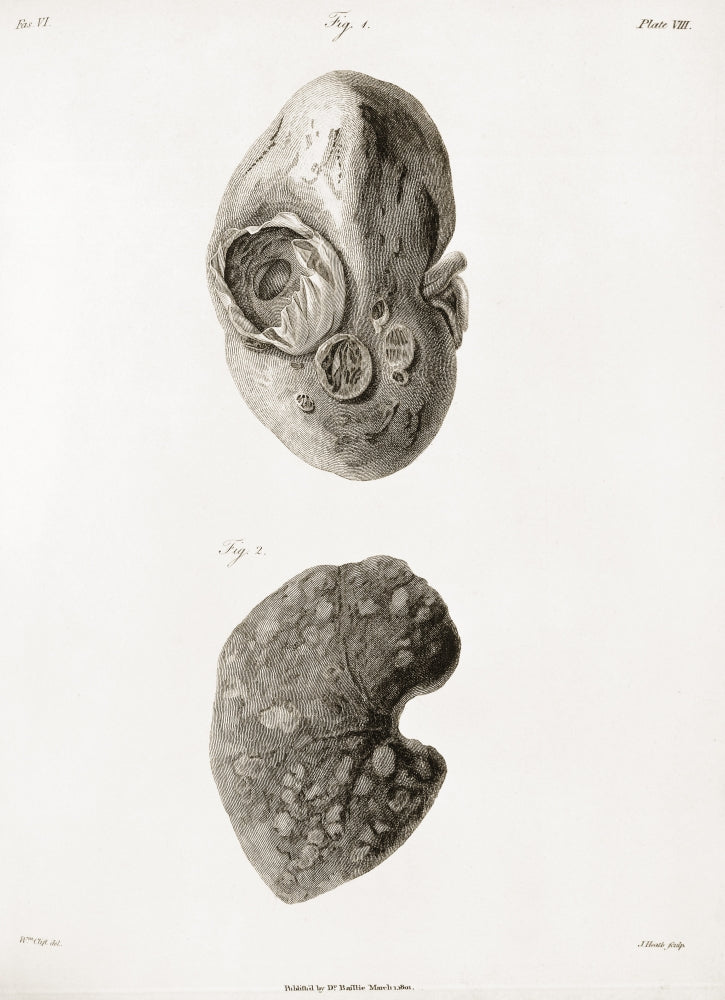 Kidney Hydatid Disease Illustration Poster Print from c.1801.