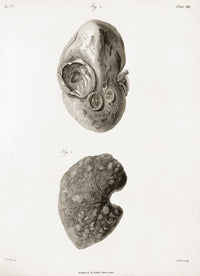 Kidney Hydatid Disease Illustration Poster Print from c.1801.