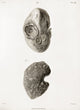 Kidney Hydatid Disease Illustration Poster Print from c.1801.