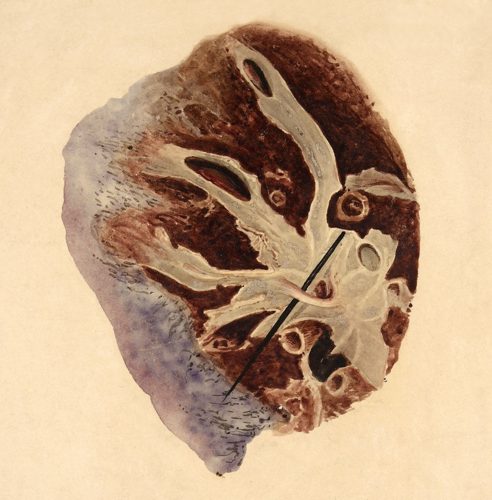 Pulmonary Clot Illustration from 1844, medical history art print