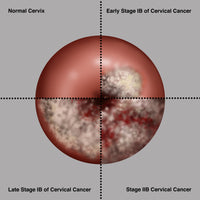 Cervical Cancer Progression Illustration Poster Print by Gwen Shockey.