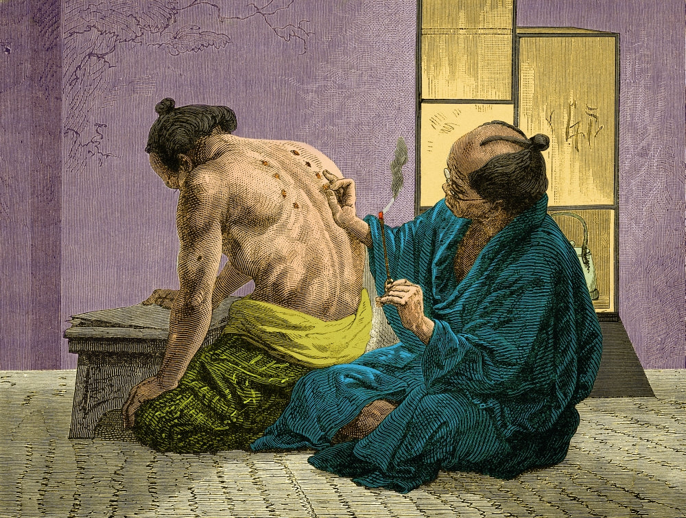 Japanese Physician Applying Moxa c.1870s Poster Print