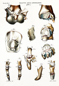 Diseased Joints from Gout Medical Illustration Poster Print