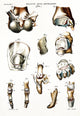 Diseased Joints from Gout Medical Illustration Poster Print