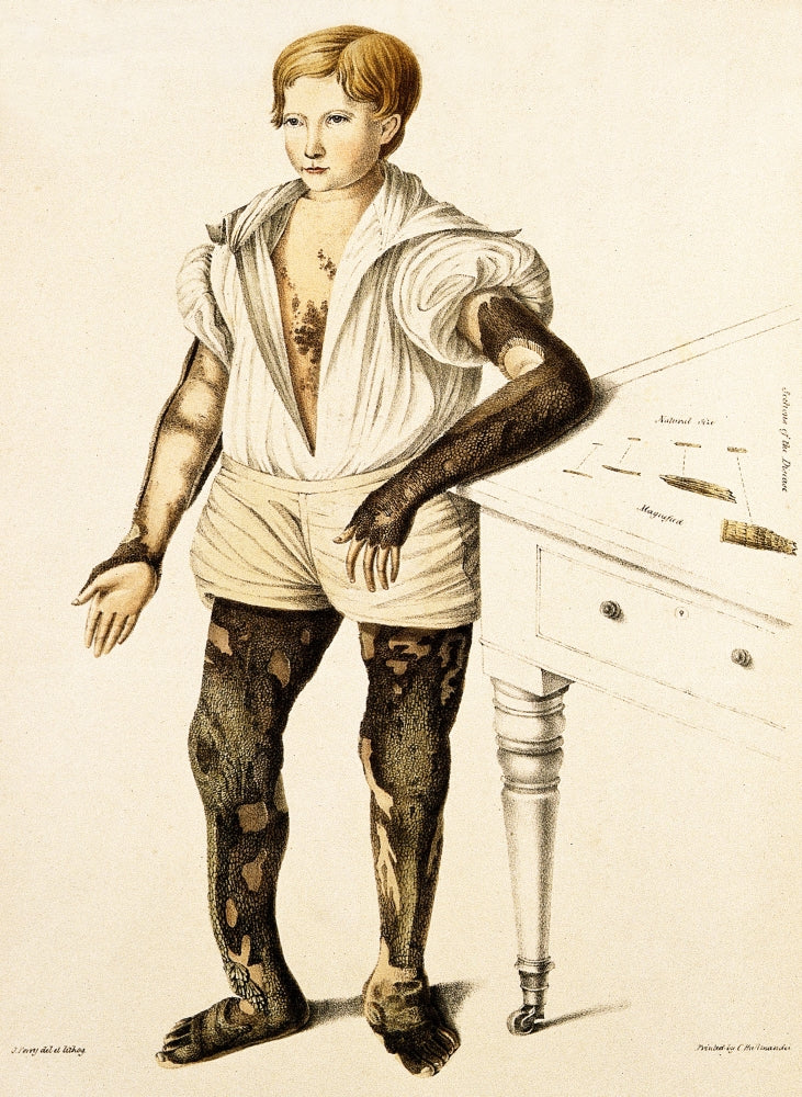 Boy with Ichthyosis Skin Disease Poster Print showcasing skin condition details.
