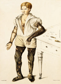 Boy with Ichthyosis Skin Disease Poster Print showcasing skin condition details.
