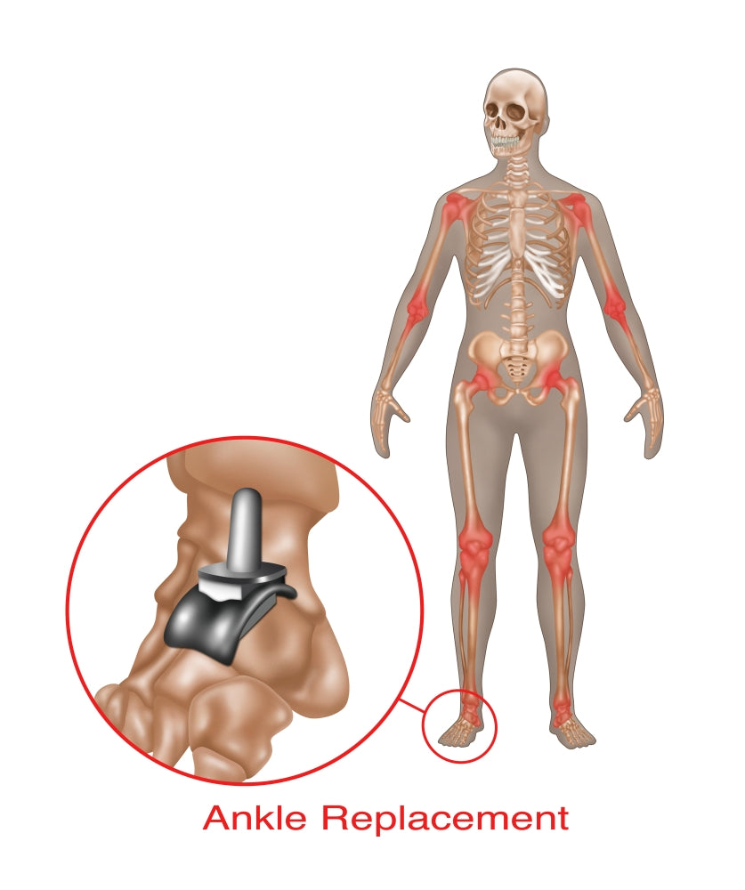Ankle Joint Replacement medical illustration poster print