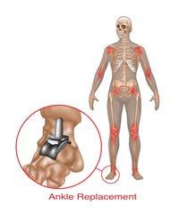 Ankle Joint Replacement medical illustration poster print