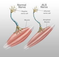 Normal Nerve and ALS Nerve Poster Print by Spencer Sutton, educational science artwork.