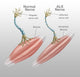 Normal Nerve and ALS Nerve Poster Print by Spencer Sutton, educational science artwork.
