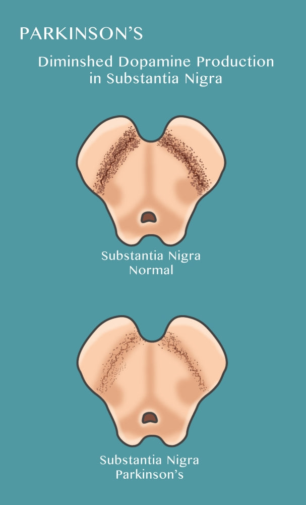 Substantia Nigra & Parkinson's Disease Poster Print showcasing detailed neuroscience illustration