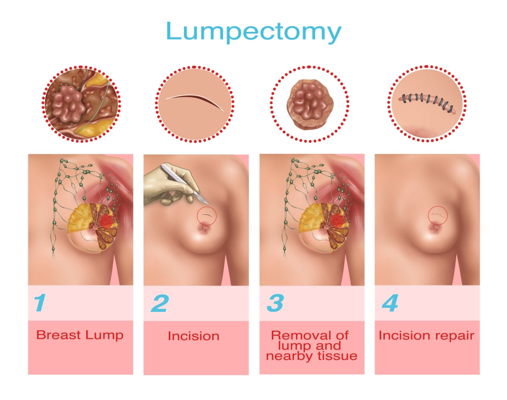 Lumpectomy Anatomical Illustration Poster Print