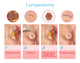 Lumpectomy Anatomical Illustration Poster Print