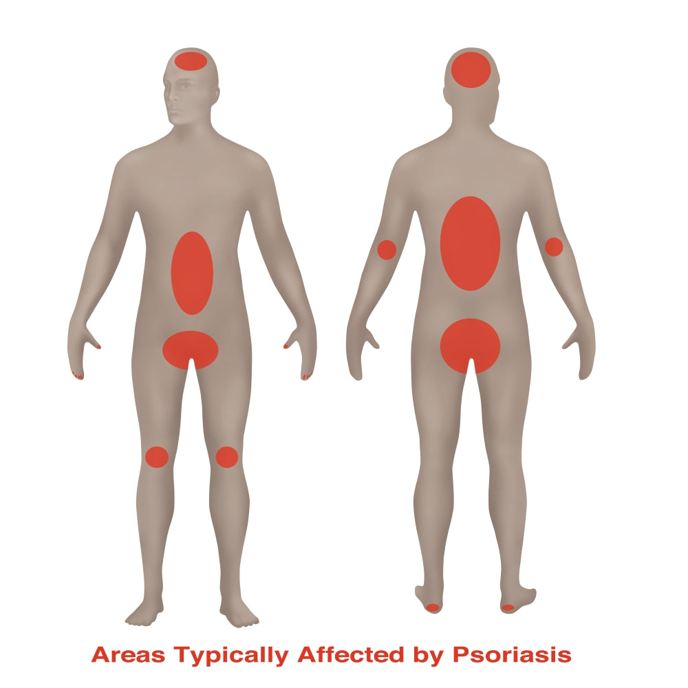 Psoriasis illustration poster print by Gwen Shockey, showcasing detailed medical artwork.
