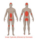 Psoriasis illustration poster print by Gwen Shockey, showcasing detailed medical artwork.