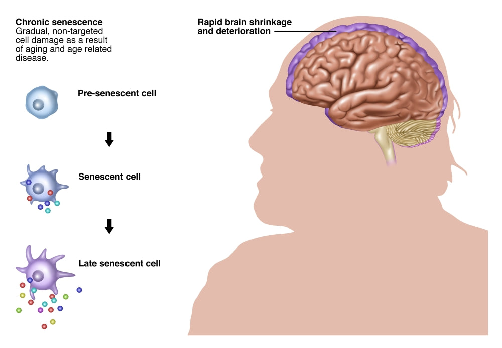 Chronic Senescence and Brain Shrinkage Poster Print showcasing brain health concepts.