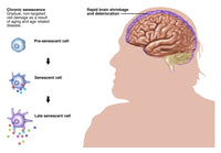 Chronic Senescence and Brain Shrinkage Poster Print showcasing brain health concepts.