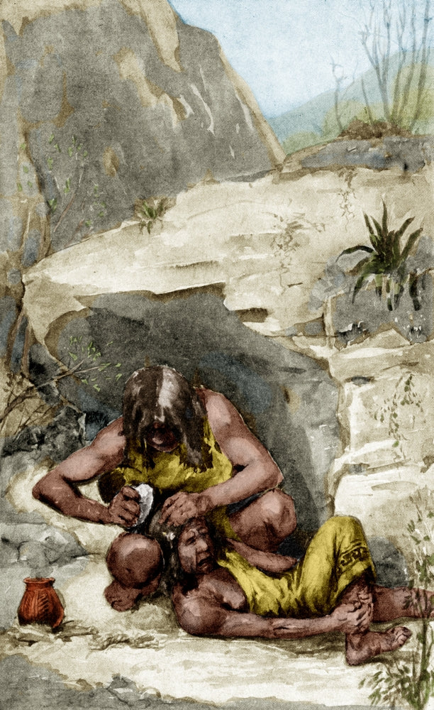 Prehistoric Surgical Operation Cautery Poster Print showcasing ancient medical practices.