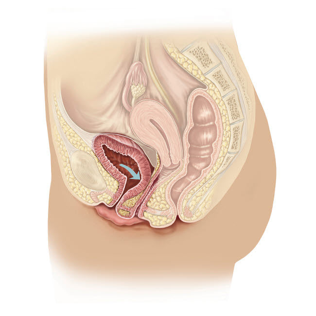 Cystocele Illustration Fine Art Print by TriFocal Communications