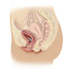 Cystocele Illustration Fine Art Print by TriFocal Communications