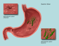 Helicobacter Pylori Infection Illustration Fine Art Print by Gwen Shockey