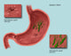 Helicobacter Pylori Infection Illustration Fine Art Print by Gwen Shockey