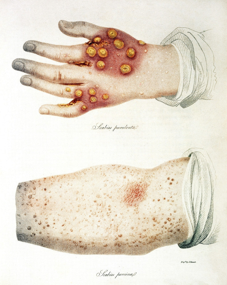 Scabies Skin Disease Illustration Fine Art Print - 1816