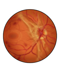 Retina with Advanced Diabetic Retinopathy Fine Art Print by TriFocal Communications